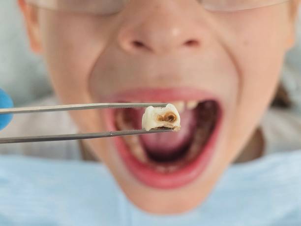 Best Broken Tooth Emergency  in Harbour Heights, FL